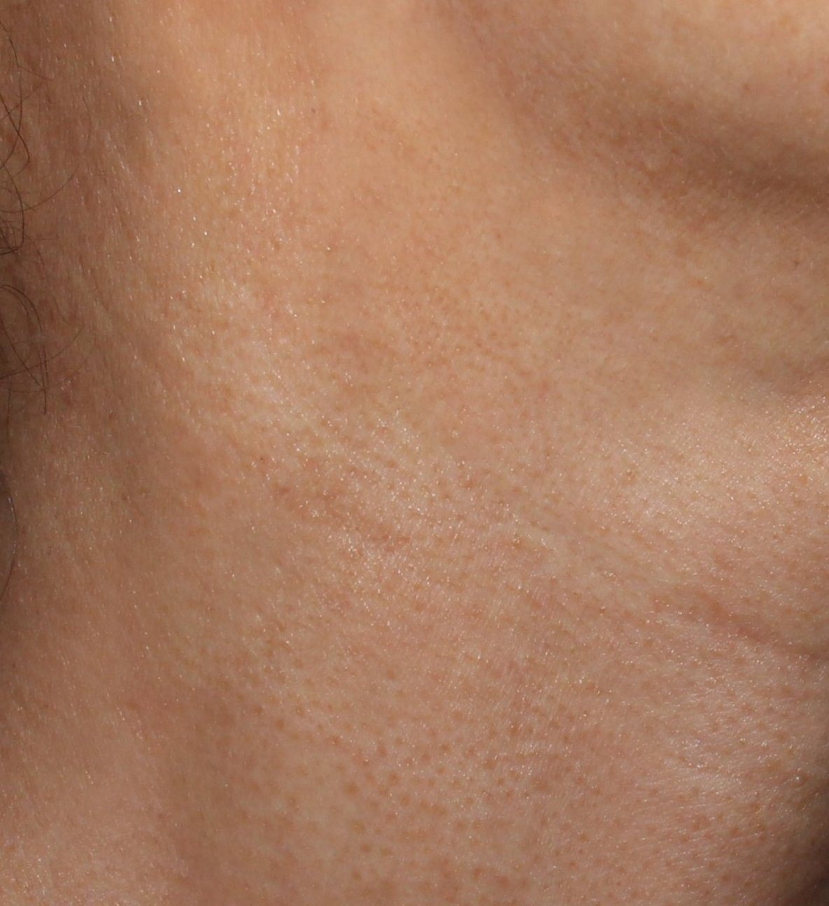 턱선·목 편평사마귀 치료 후
