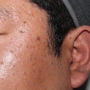 얼굴 편평사마귀·검버섯·피지선증식증 치료 전